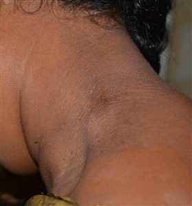 After Skin Tag treatments