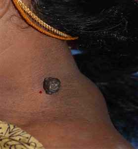 Before Skin Tag treatments