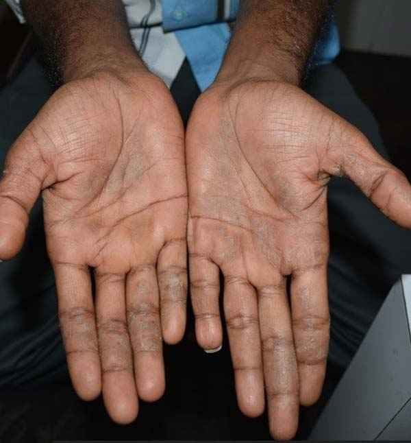 After skin treatment for palm infection at Adityan Skin Clinic in Madurai