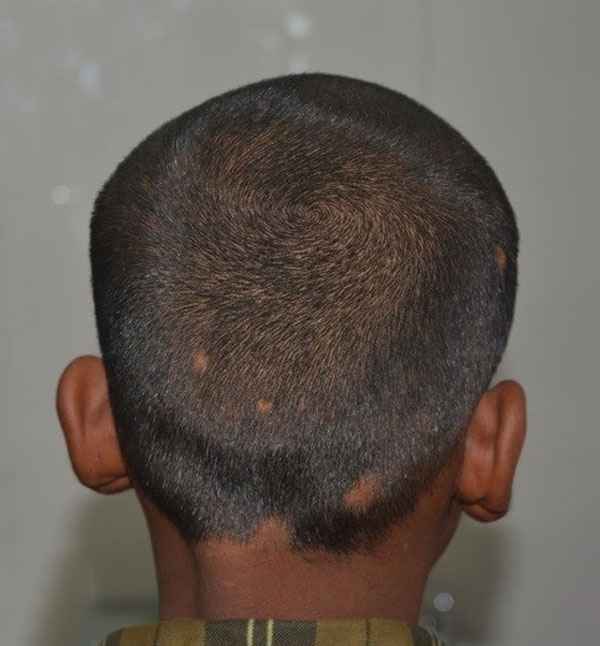 After scalp treatment with improved hair regrowth at Adityan Skin Clinic in Madurai