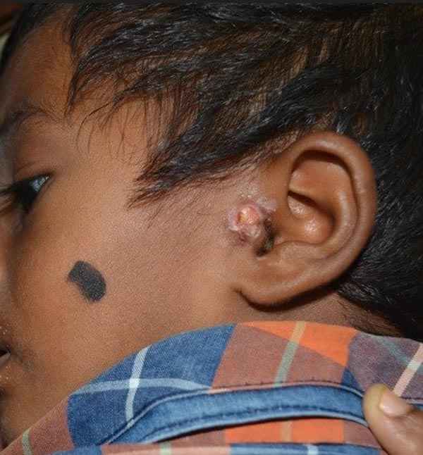 After ear keloid removal treatment at Adityan Skin Clinic in Madurai