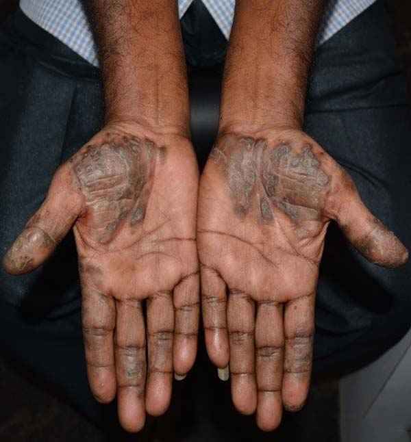 Before skin treatment showing palm infection at Adityan Skin Clinic in Madurai