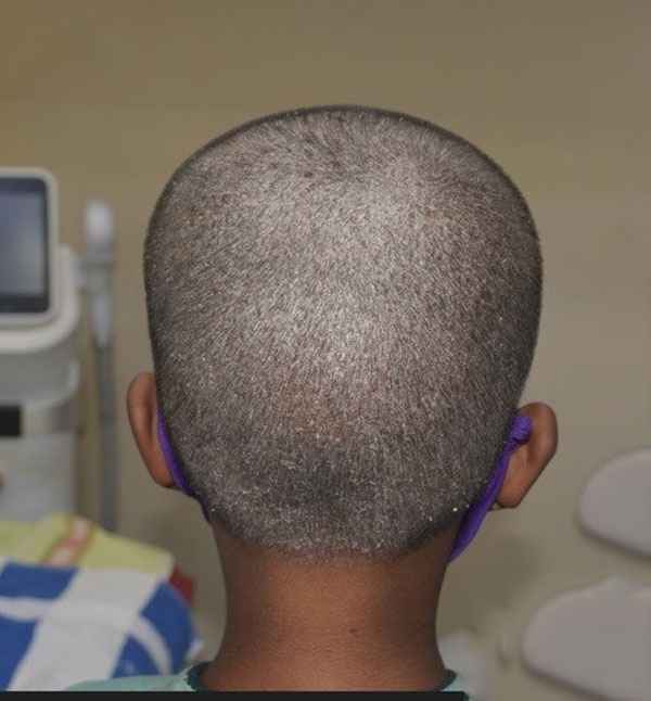 Before scalp treatment showing hair patch loss at Adityan Skin Clinic in Madurai