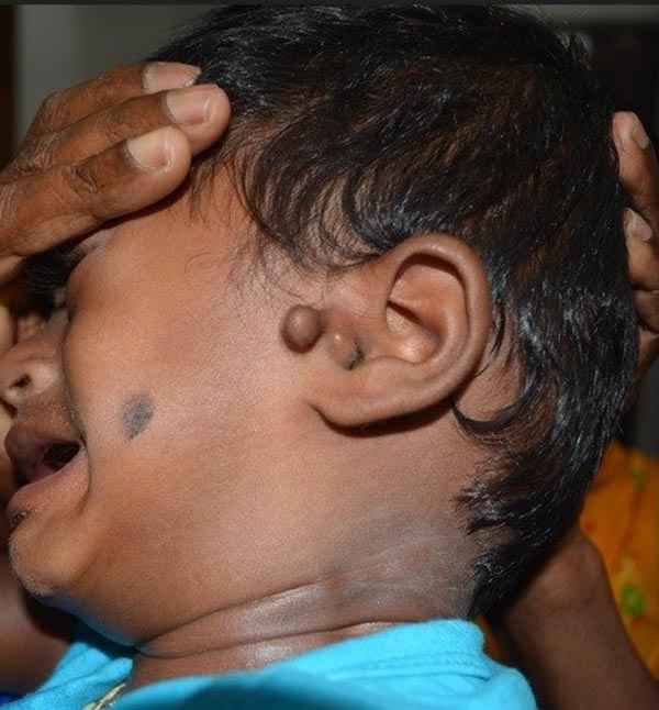 Before ear keloid treatment showing swelling at Adityan Skin Clinic in Madurai