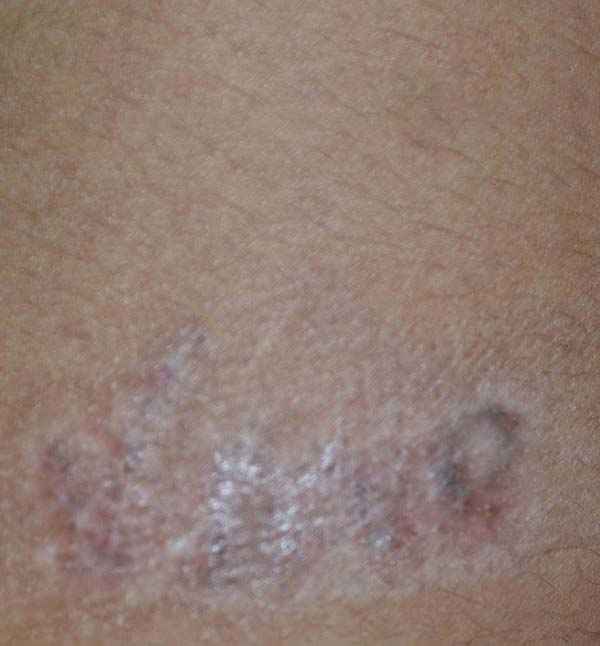 After successful laser tattoo removal treatment at Adityan Skin Clinic in Madurai