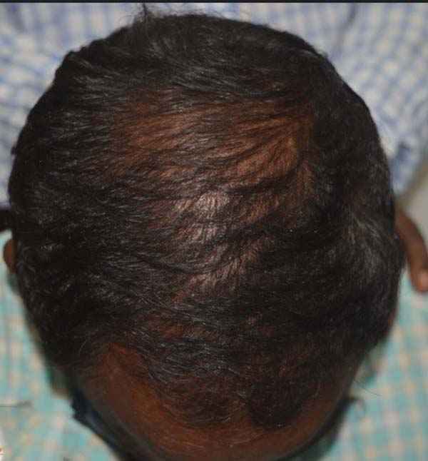 After hair regrowth treatment at Adityan Skin Clinic in Madurai