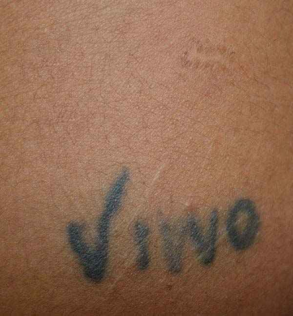 Before laser tattoo removal treatment at Adityan Skin Clinic in Madurai