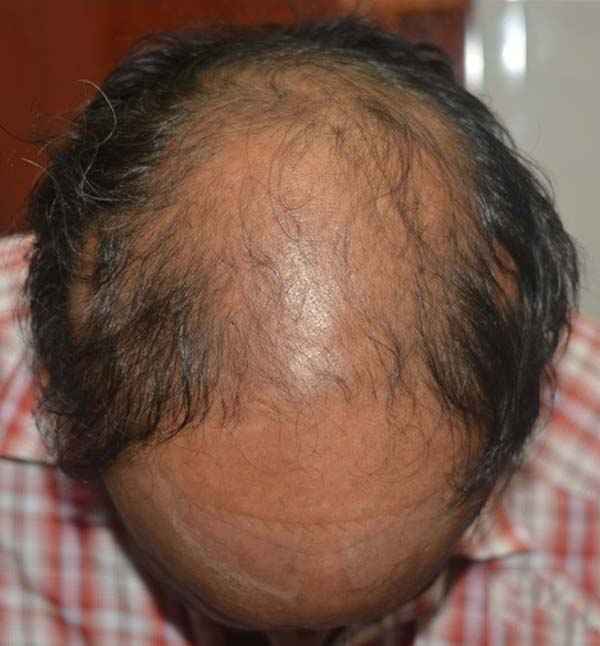 Before hair regrowth treatment at Adityan Skin Clinic in Madurai