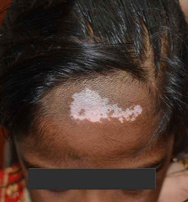 Before treatment showing forehead hair loss patch at Adityan Skin Clinic in Madurai