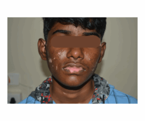 Read more about the article Vitiligo Treatment in Chennai: Regain Your Confidence with Expert Care