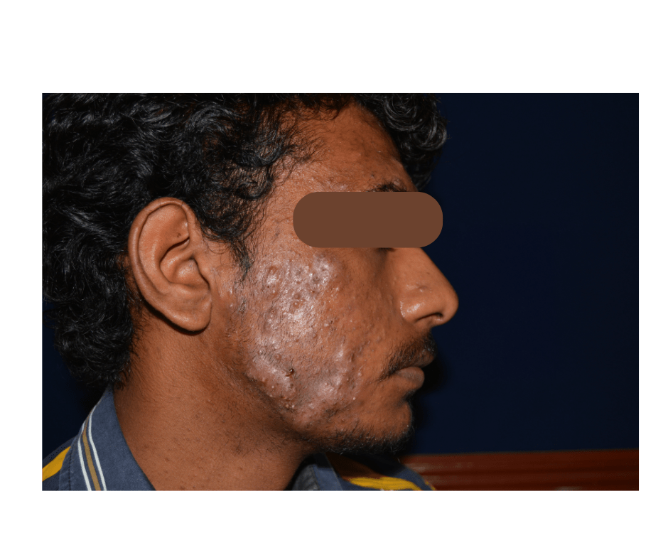 Psoriasis Treatment in Chennai: How Adityan Skin Clinic Can Help You Regain Clear Skin